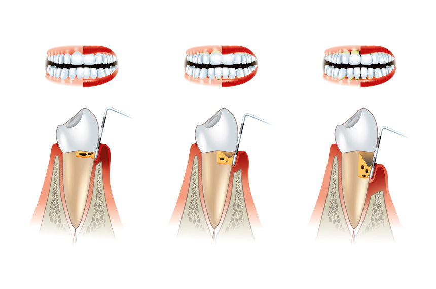 periodontitida